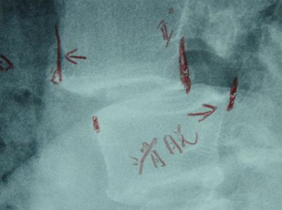 椎体滑脱治疗前显示X影像图